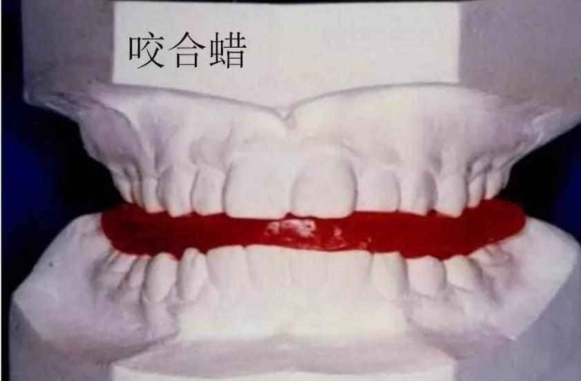 咬合記錄矽橡膠和蠟片的區(qū)別